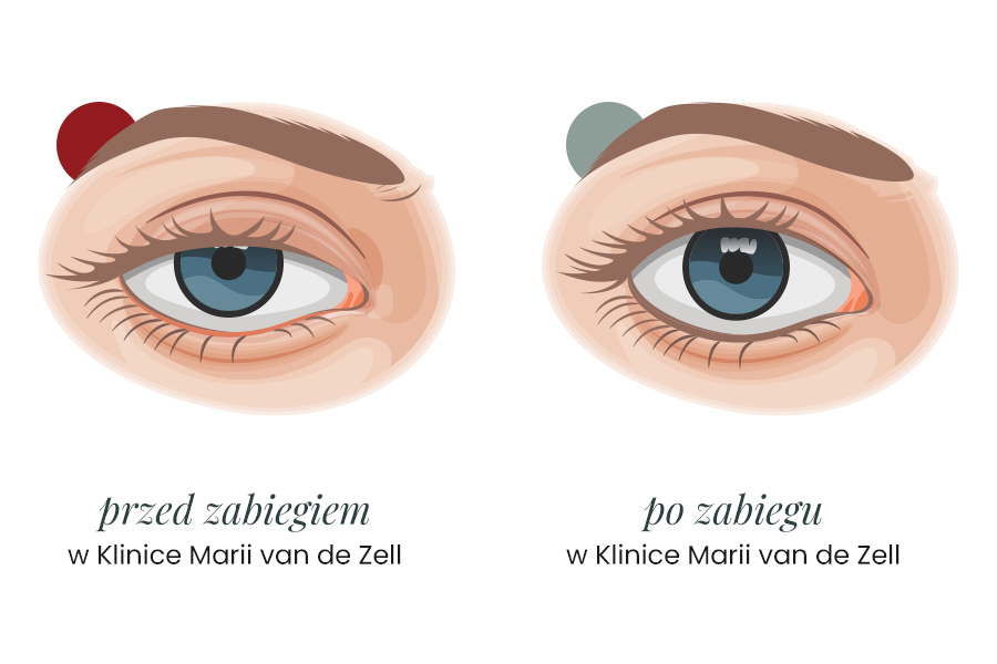 Blefaroplastyka grafika zabiegowa